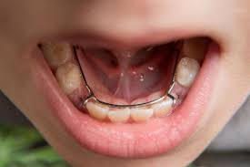 Pediatrics (Space Maintainer)